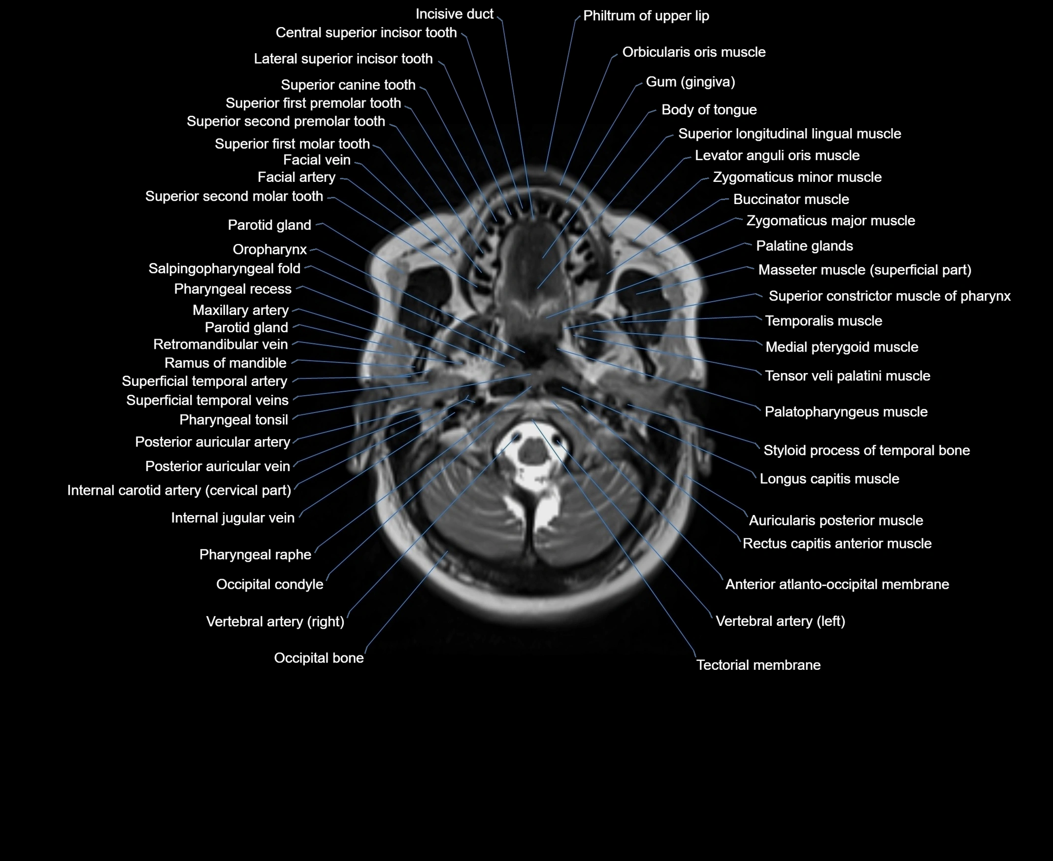 MRI Neck 3D labelled cross section anatomy axial 3t image-00001-00020.webp